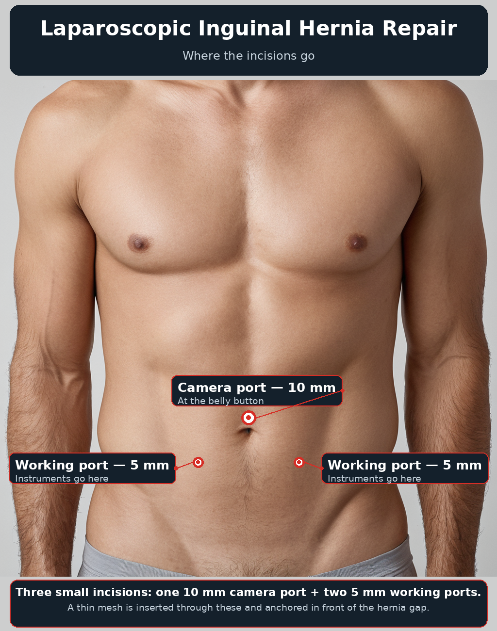 Hernia & Laparoscopic Mesh Surgery: What It Is, Why You Got It, and What Happens Next